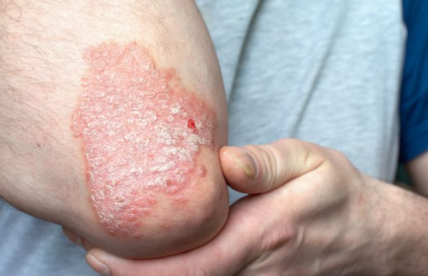 Vảy nến: Vấn đề ngoài da ảnh hưởng sức khỏe sinh sản nam giới