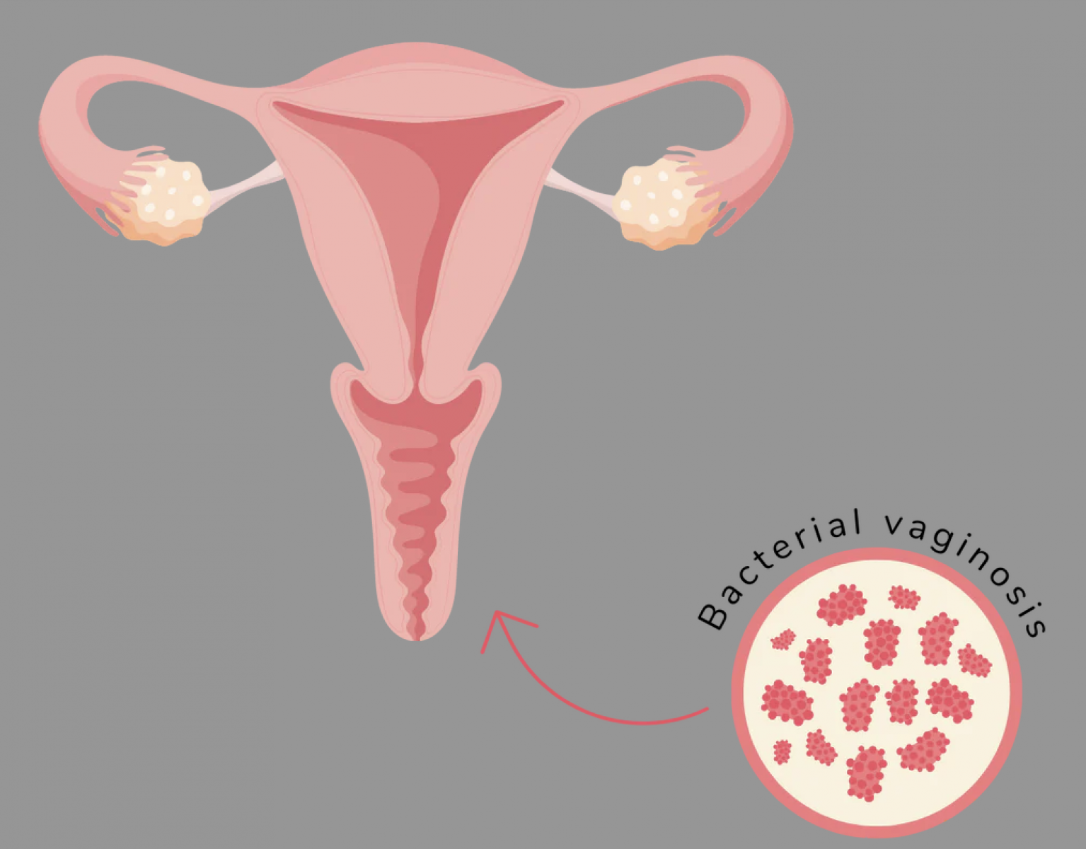Viêm âm đạo do Bacterial Vaginosis