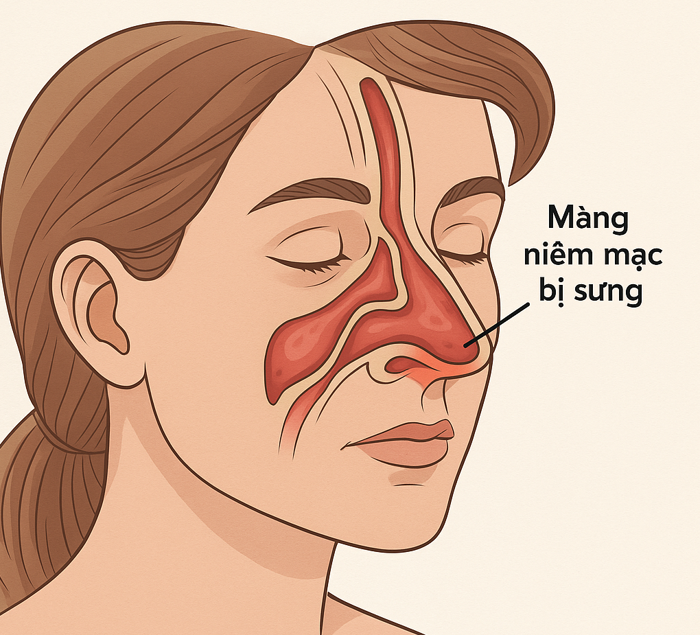 Minh họa cấu trúc khoang mũi và vị trí gây nghẹt mũi