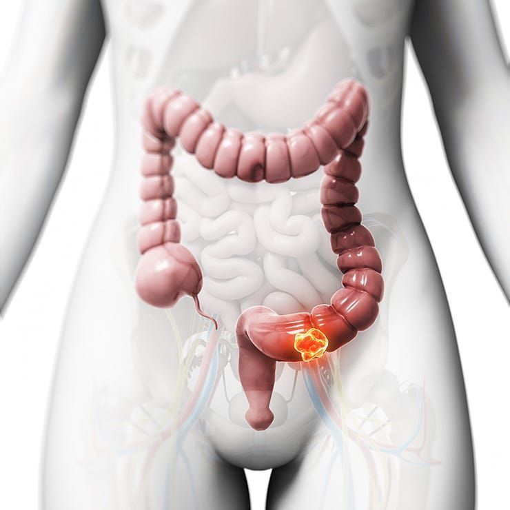 Chất xơ làm giảm tình trạng ung thư đường tiêu hoá