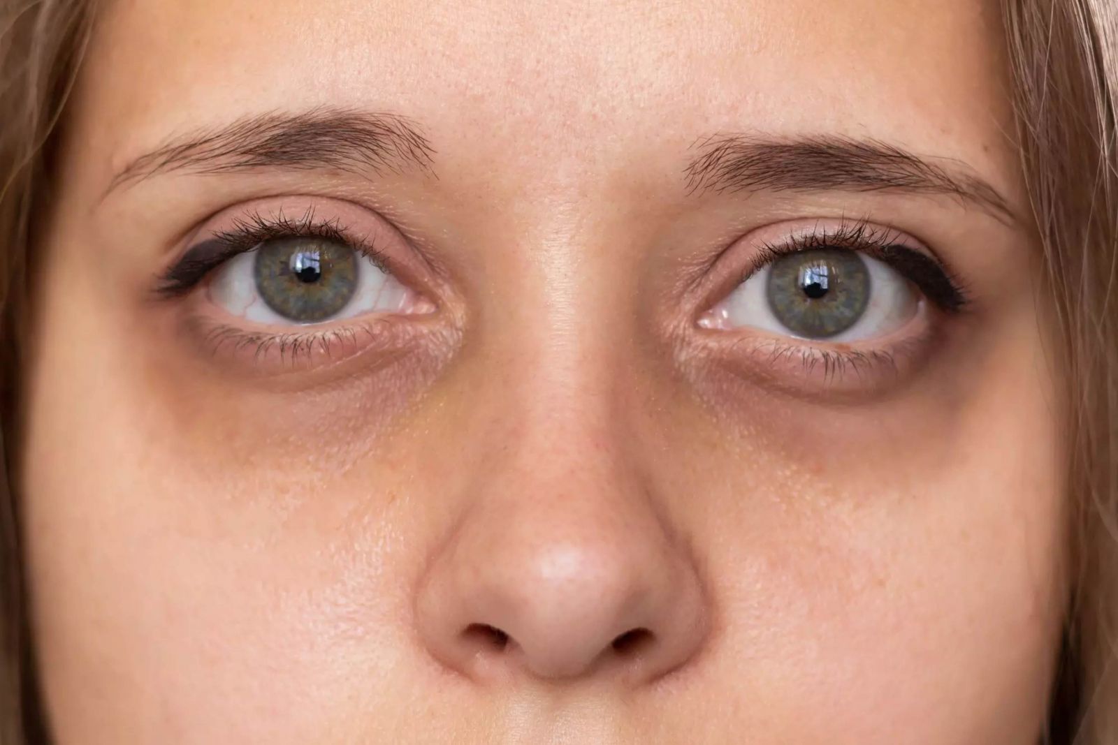 Mắt thâm quầng do thức khuya