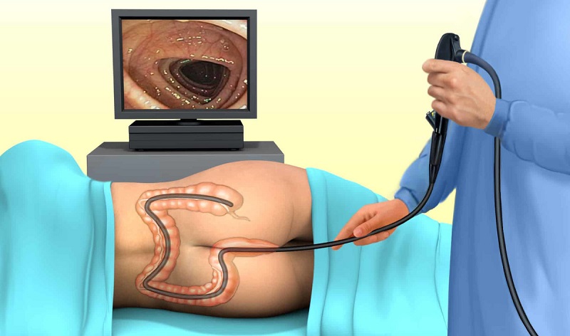 Quy trình nội soi đại tràng với ống soi có gắn camera