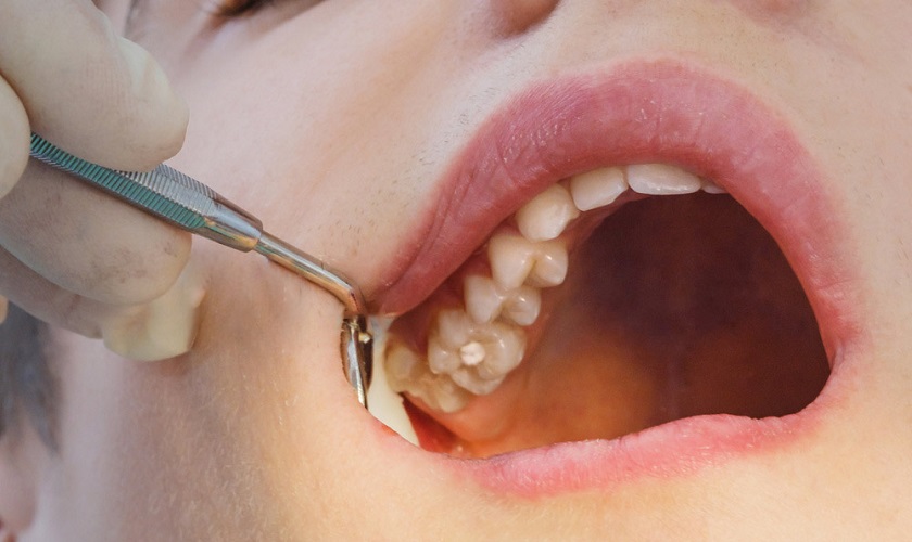 Viêm xoang hàm có thể gây đau vùng má và lan lên răng hàm trên
